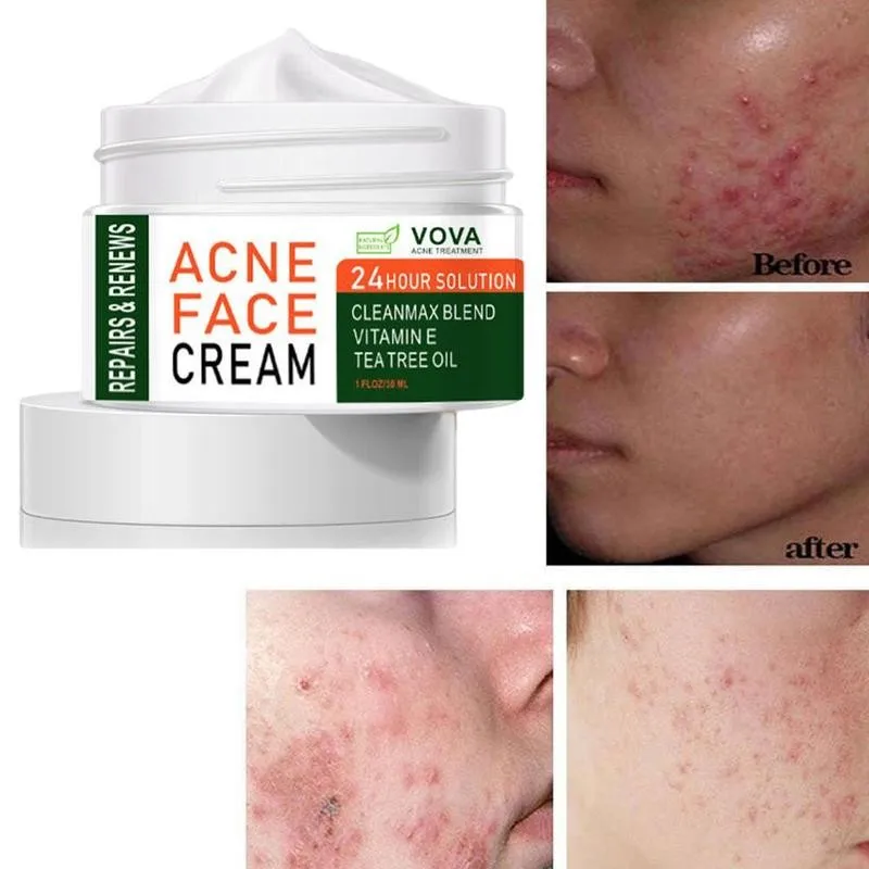 

Acne Removal Cream Fade Acne Spots Pimple Oil Control Cream Care Pores Acne Shrink Whitening Skin Treatment Acne Moisturizi K0N3