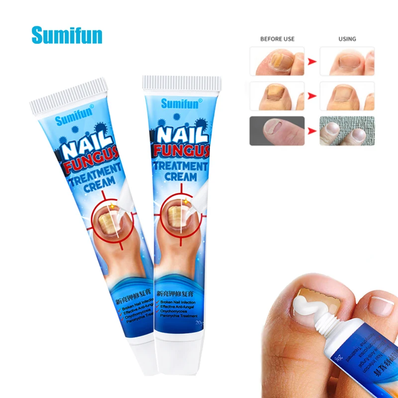 

20g Nail Fungus Removal Ointment Onychomycosis Fungal Nail Treatment Paronychia Anti Infection Feet Toe Fungal Nail Care Cream