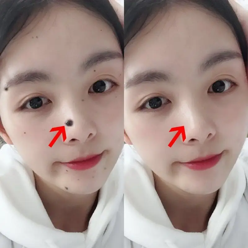 20 мл темное пятно моль ремонт роза эфирное масло кожа тег Веснушка