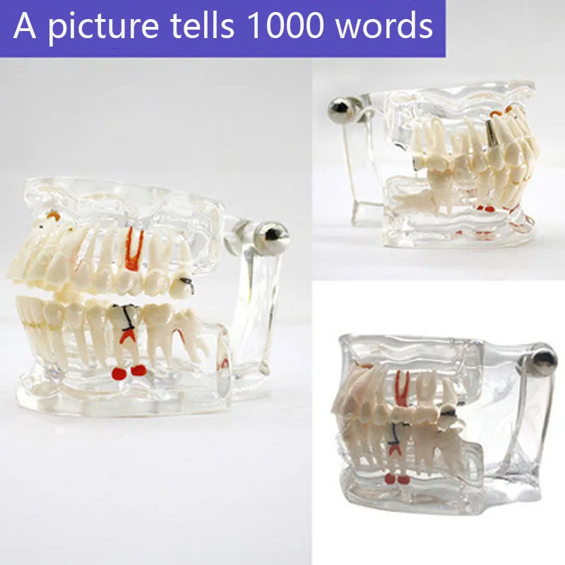 

Зубы прозрачные взрослые патологические модели для стоматологического Кабинета взрослые патологические зубы модель 2003