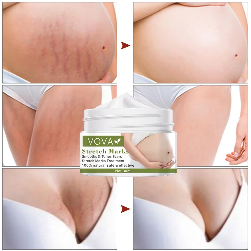 

30ml Remove Stretch Mark Cream