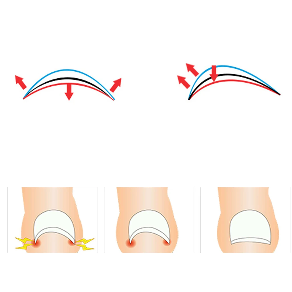 

100pcs Ingrown Toenails Straightening Nail Stickers Clips 8 Sizes