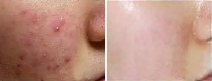 

1 box / 2 boxes-Vitamin A Gel 0.1% Clears Blackheads, Acne and Other Acne Symptoms Acne print 15g/box