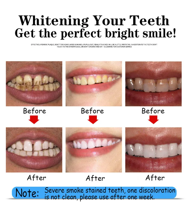 Набор для отбеливания зубов очищение быстрое удаление пятен уход за полостью рта