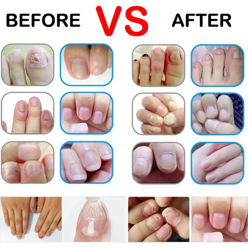 3ml Natural Herbal Toenail Fungus Nail Fungal Treatment Pen Nutrient Solution Feet Care Manicure Repair Gel Essence Tool | Красота и