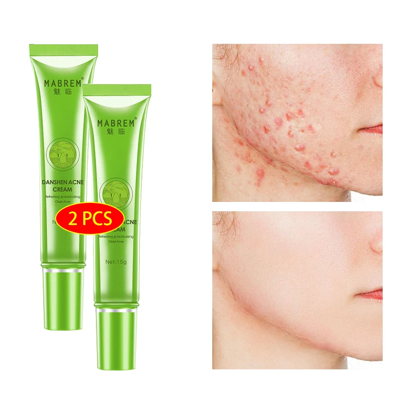 

2pcs Effective Acne Removal Cream Treatment Acne Scar Spots Oil Control Shrink Pores Whitening Moisturizing Anti-Acne Face Care