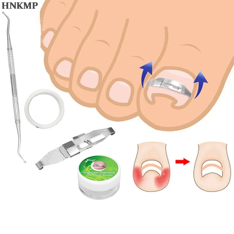 1 компл. Инструмент для лечения вросших ногтей инкрустированная Пряжка
