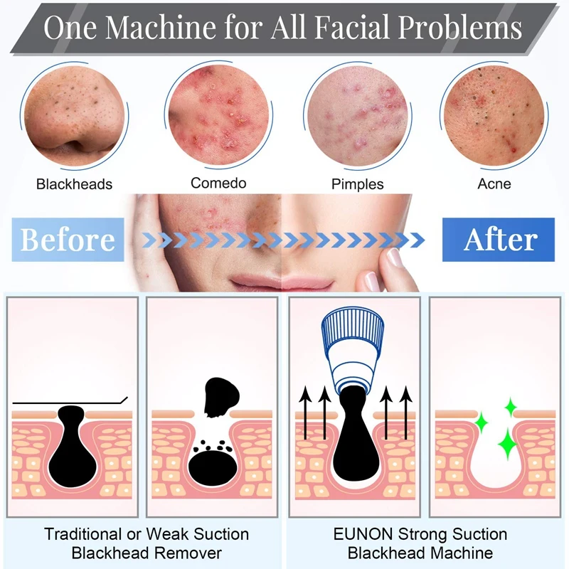 

Face Blackhead Remover Vacuum Suction Pore Cleaner Face Deep Nose Cleasning Pimple Removal with Tool