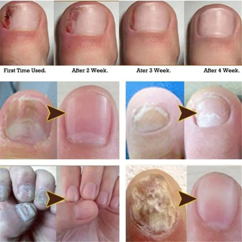 

Anti Fungus Fungal Nail Treatment Essence Repair Toe Nail Finger Care Infection with Nails File