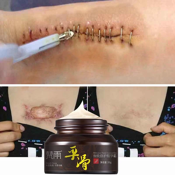 

Plant Extract Repair Smoothing Cream Scar Surgical Burn Scar Repair Cream Face ZGOOD