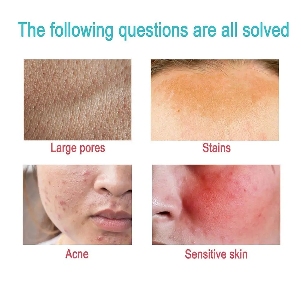 

Tea Tree Acne Cream Repair And Fade Acne Marks Acne Pores Cream Marks Reduce Acne Acne Cream Shrinks T4G7