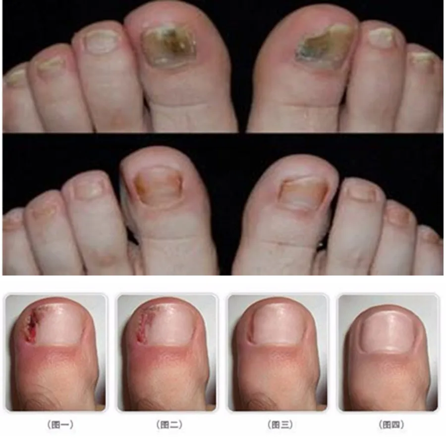 Ноги рук гриб мертвой Уход за ногтями Onychomycosis лечение удалить смягчающее масло стерилизации кутикулы парафин восковой крем