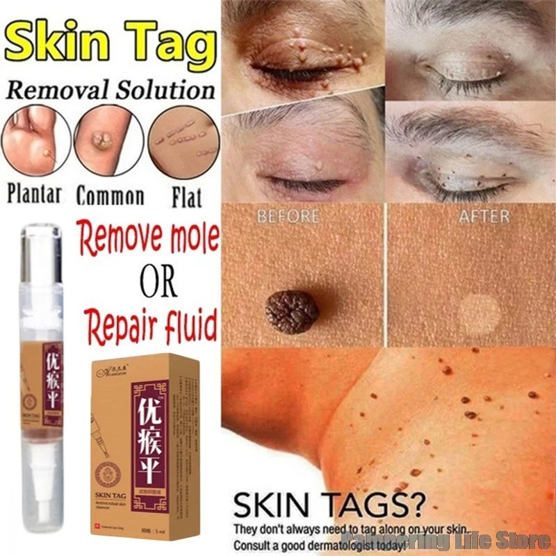 

Skin Tag Remover Against Mole & Genital Wart Anti Foot Corn Removal Warts Papillomas