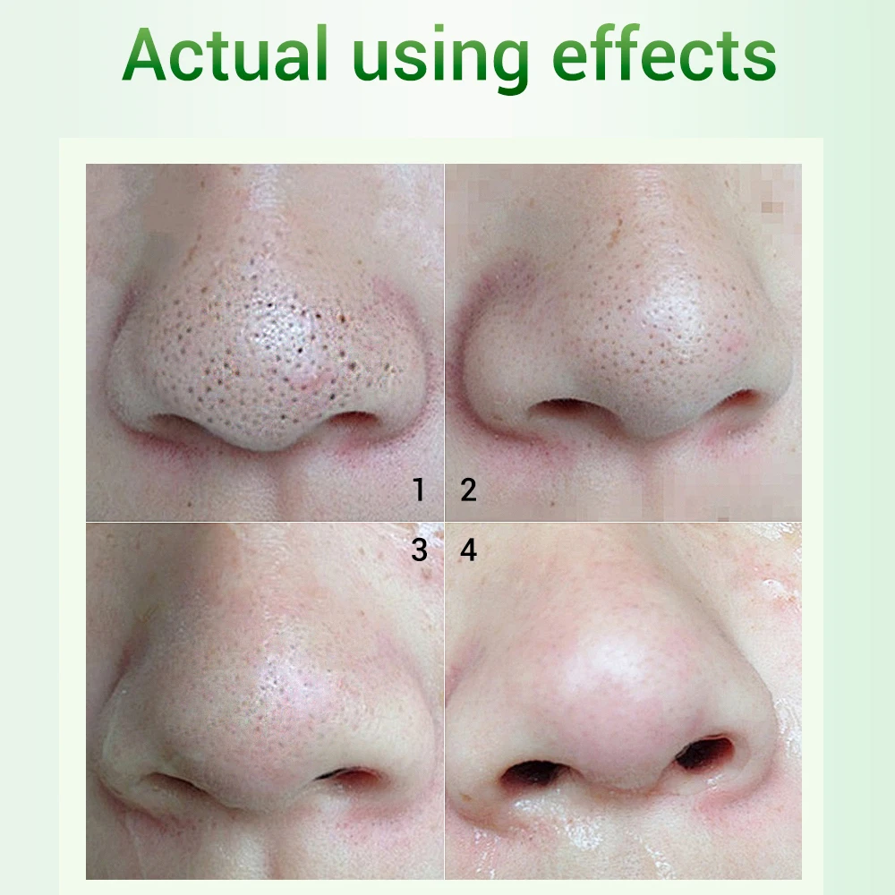 Маска для удаления черных точек BREYLEE Эфирная жидкость ухода за кожей | Красота и