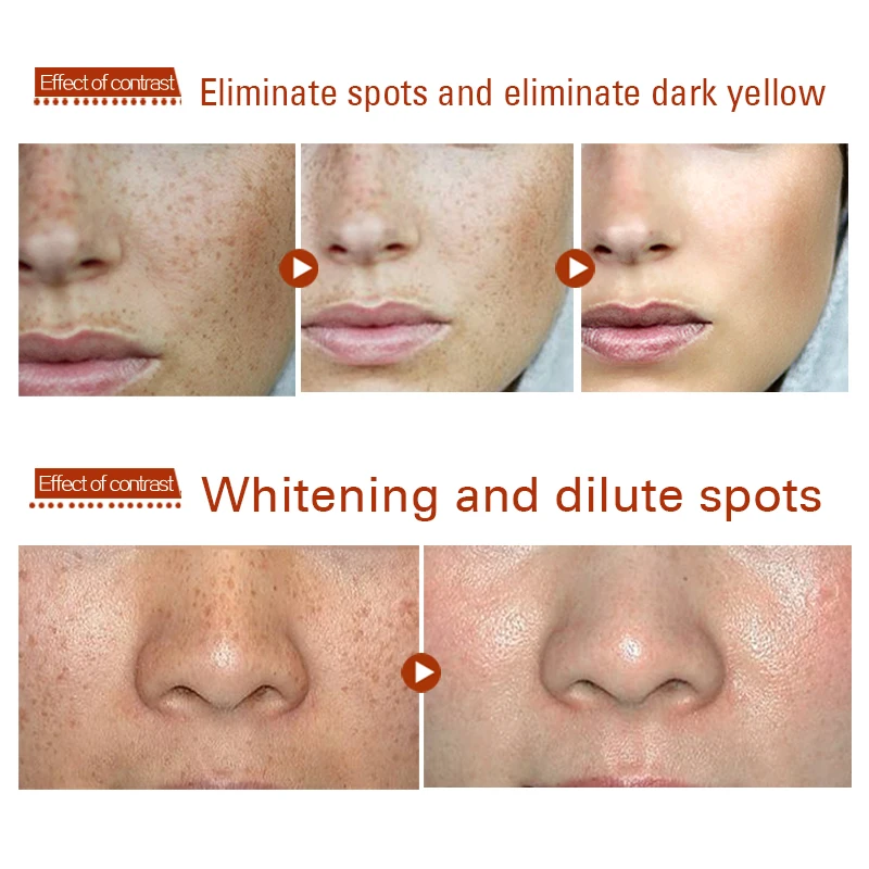 

1pcs Freckles Melasma Cream 15ml Dark Spot Corrector Remove Warts Fade Cream Removal Black Spots Moles Serum Reduces Age Spots