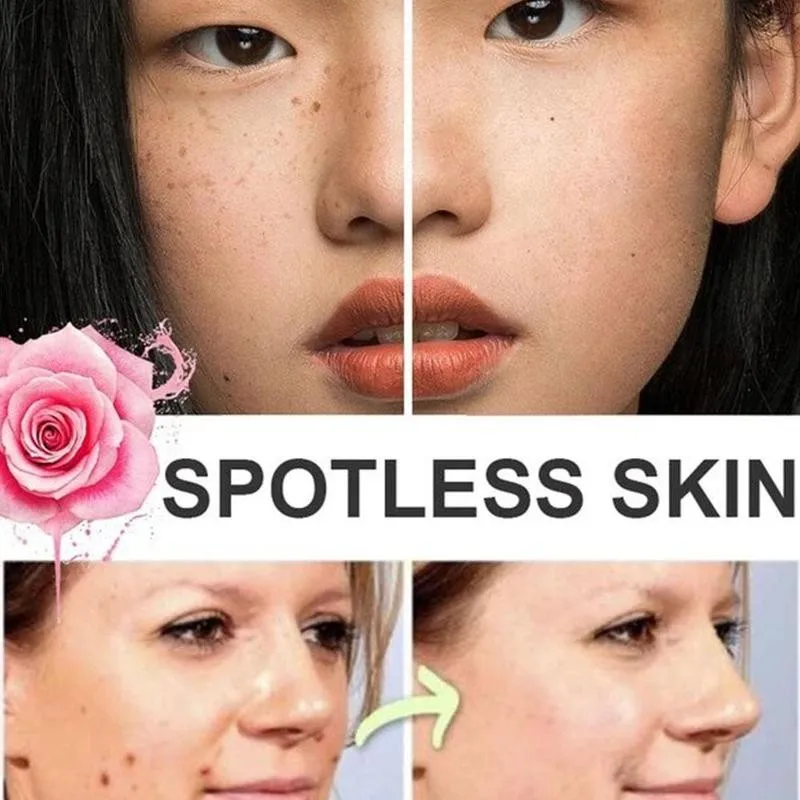 Жидкость для удаления родинок и веснушек 20 мл бородавка родинка немаркие