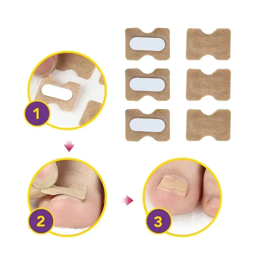 

New Non-Glue Toenail Patch Ingrown Toenail Correction Tool Pedicure Professional Painless Toenail Patch Breathable 1.8*1.3cm