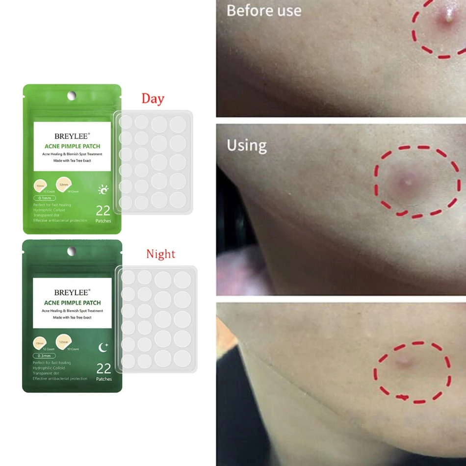 

Invisible Acne Removal Patches Fast Absorb Acne Secretions Effectively Remove Pimples Acne Treatment Mask Skincare