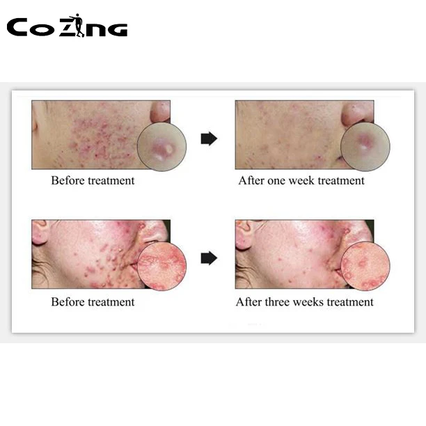 

Home Rehabilitation Therapy Red Blue Light Therapy Device For Acne Treatment