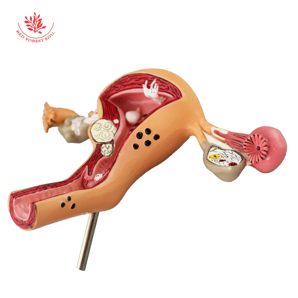 Модель матки анатомическая патологическая структура женских репродуктивных