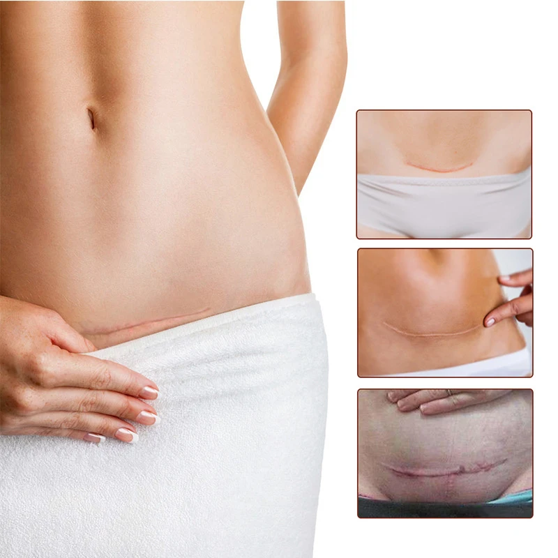 Удаление шрамов крем уход за кожей лица от угревой сыпи шрам стрейч Знаки лечение