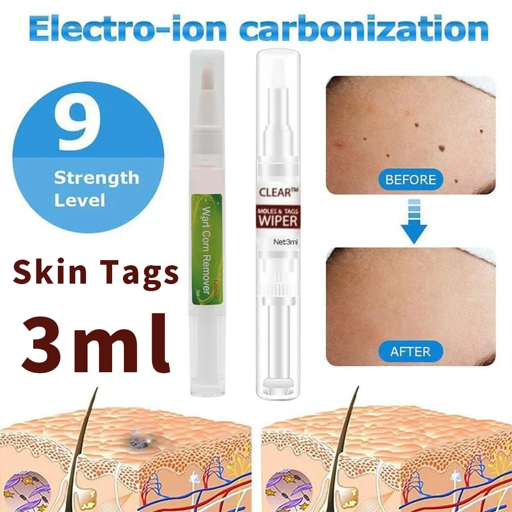 Новинка 3 мл лечение половых органов удаление папилломы бородавок жидкость с