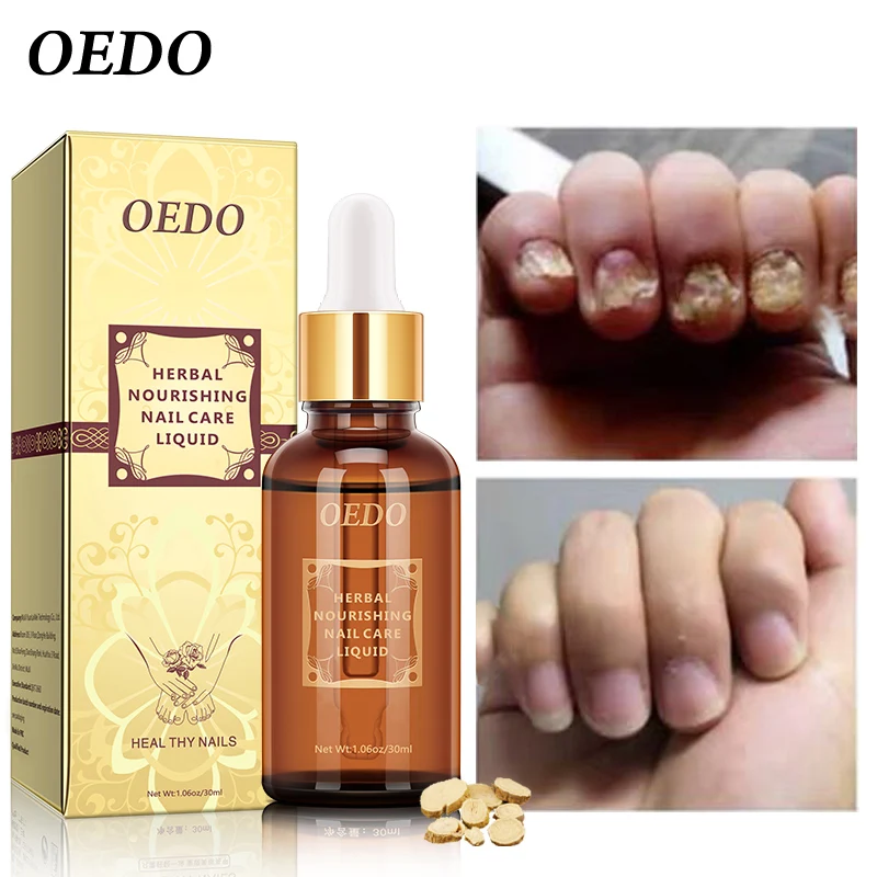 Натуральное травяное масло для ногтей противогрибковое Отбеливающее средство