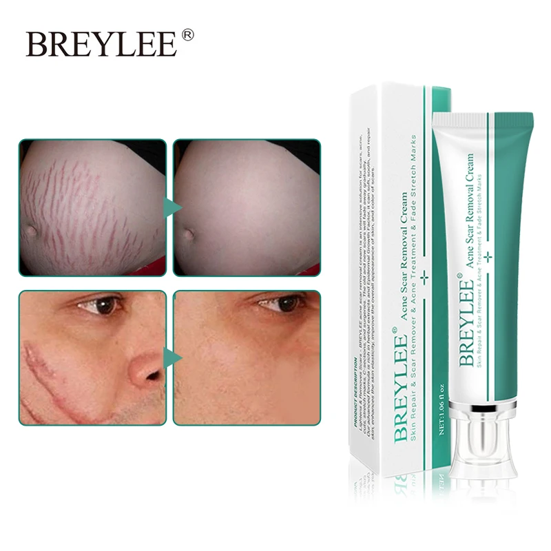 

Acne Scar Removal Cream Pimples Stretch Marks Lighten Scar Removal Acne Treatment Whitening Nourishing Deep Skin Care 30g