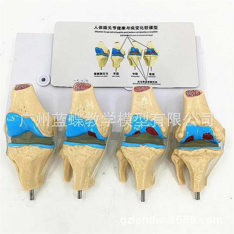 

4 pcs Human pathological knee joint model Degenerative arthritis of knee joint