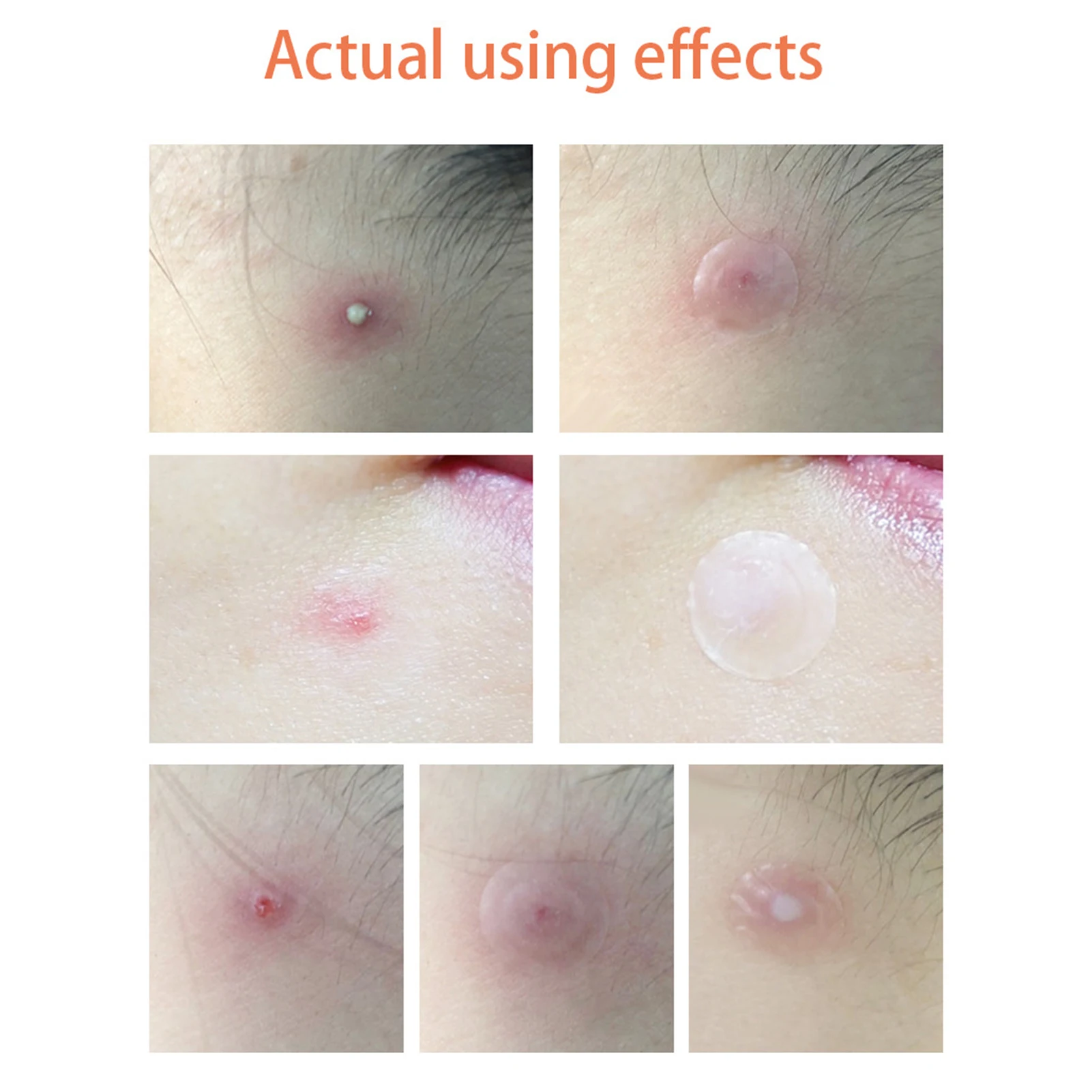 LANBENA Waterproof Day Use Acne Sticker Pimple Remover Patch Skin Care Treatment