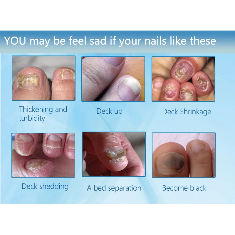 Горячая ногтей антибактериальное масло ремонт питание противогрибковый Яркий