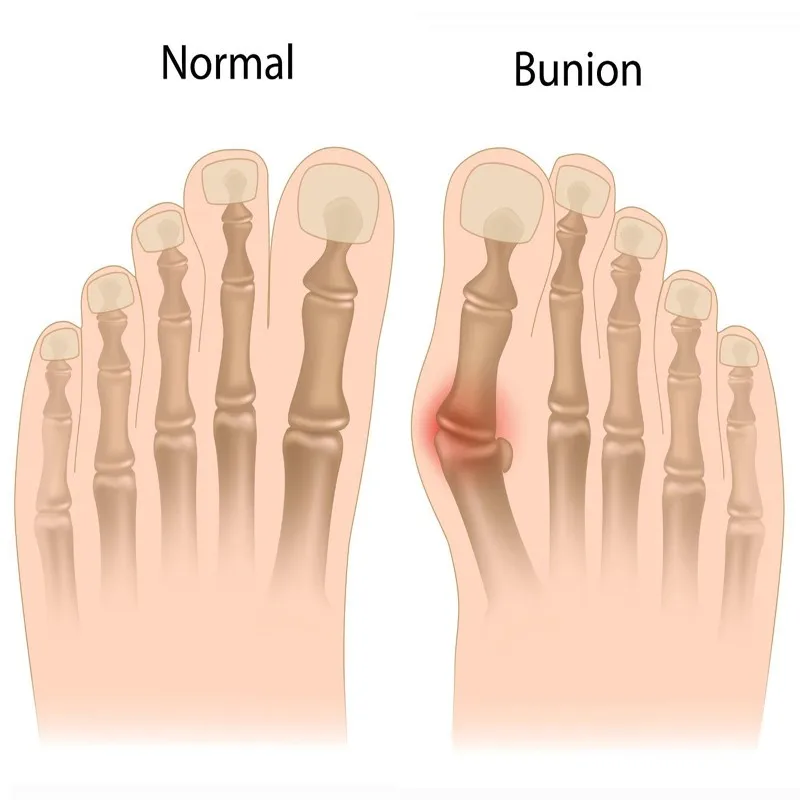 OPHAX 1 пара корректор для косточки на ноге устройство Bunion разделитель для пальцев ног большой палец ночной ортопедический подтяжки защита ноги шина
