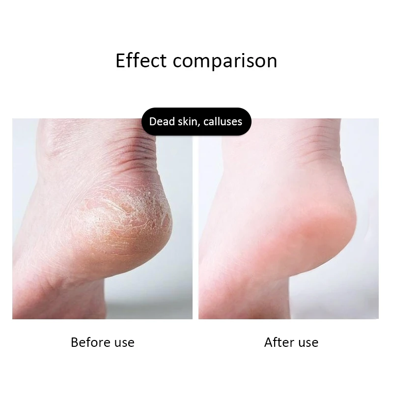 Рашпиль для ног из нержавеющей стали пластиковая ручка средство удаления