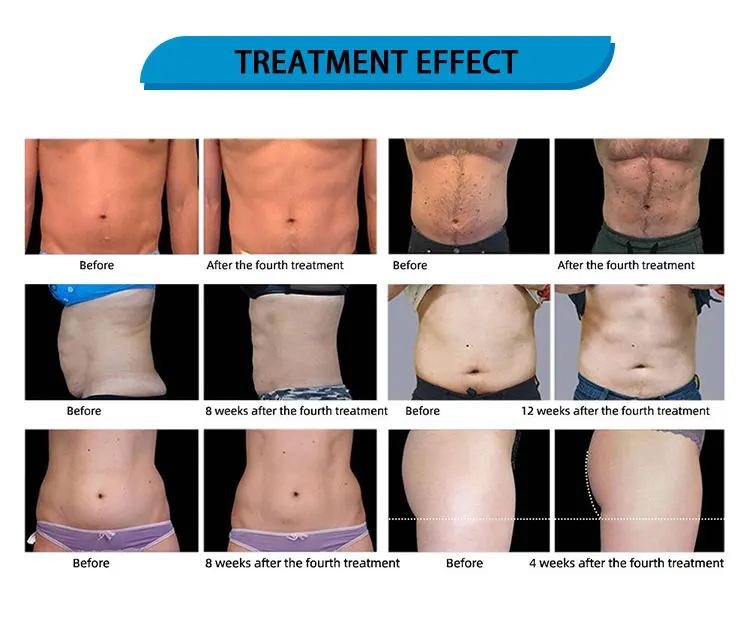 

Free shipping Factory Sale HIEMT Emslim Electromagnetic Muscle Sliming Device No Pain Hifet for spa/Gym