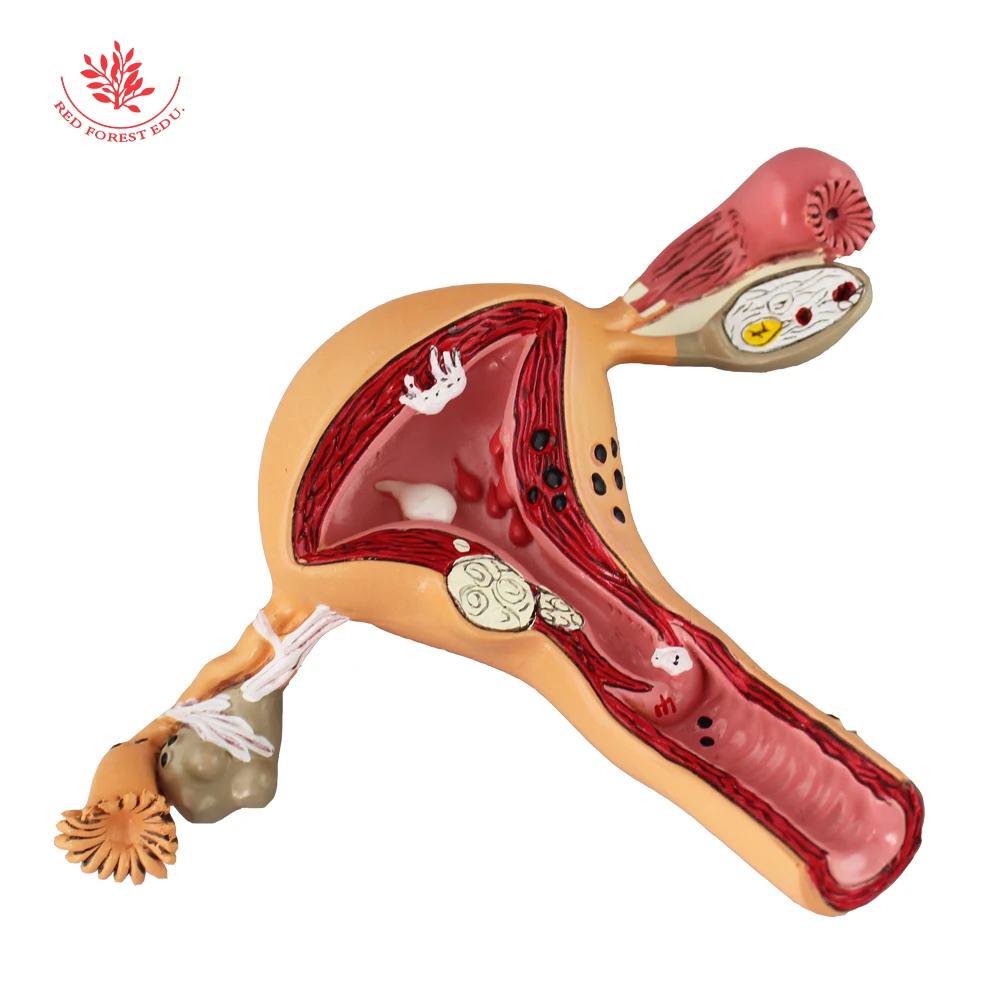 Модель матки анатомическая патологическая структура женских репродуктивных
