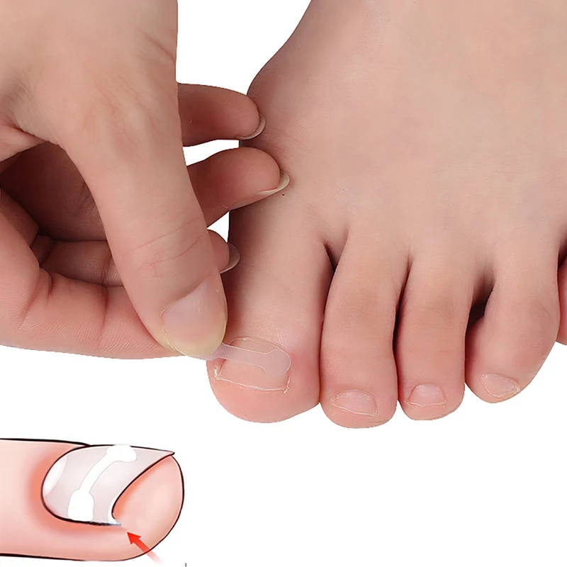 10 шт./коркор. наклейка для коррекции вросших ногтей патч коррекция паронихии