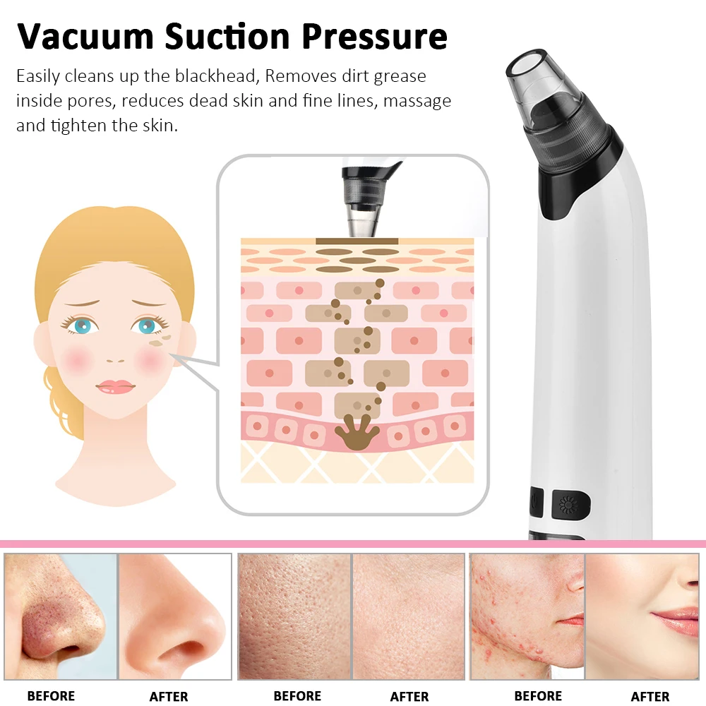 Electric black head remover Vacuum Suction Point Noir Acne Pimple Extractor Blackhead Remover Tool Facial Pore Cleaner Machine | Красота и