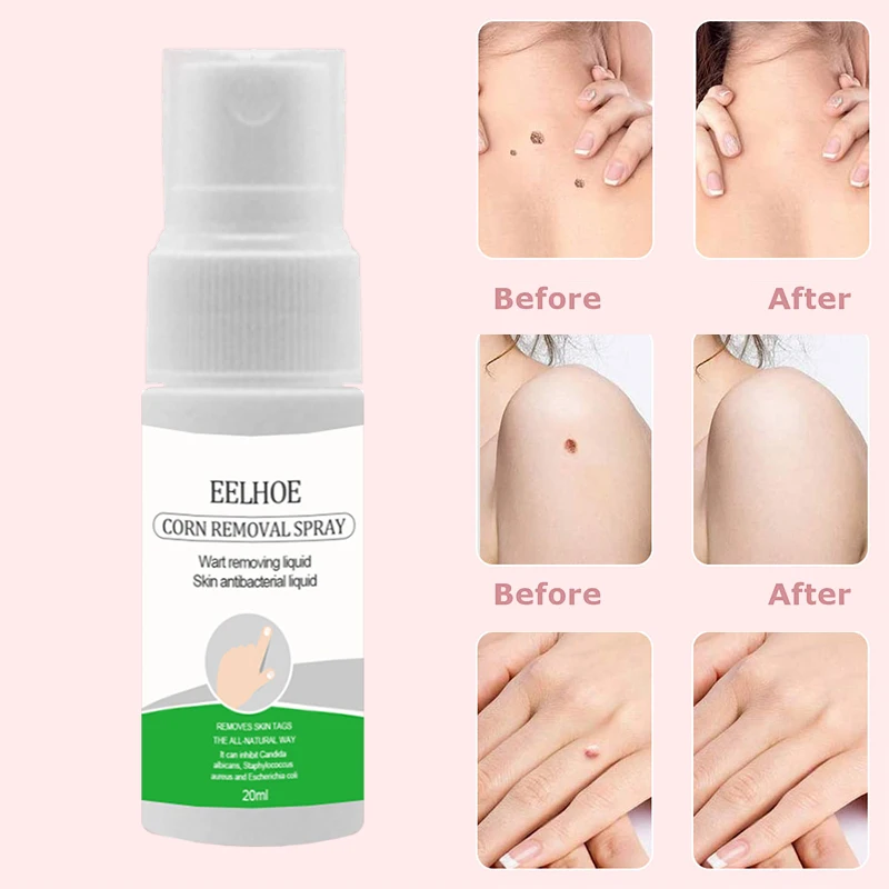 

1PC Skin Tag Remover Genital Wart Treatment Removal Mole Papillomas Foot Corn Repair Tool Natural Bacteriostatic Liquid