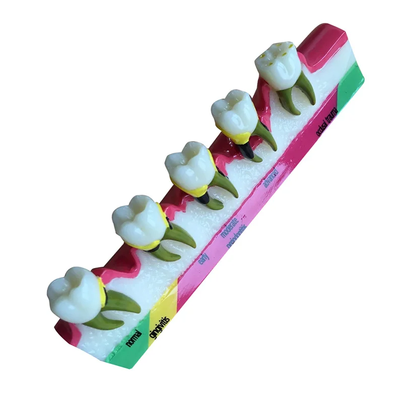 Стоматологическая модель зубов Пародонтоз ассортная классификации зубов|dental