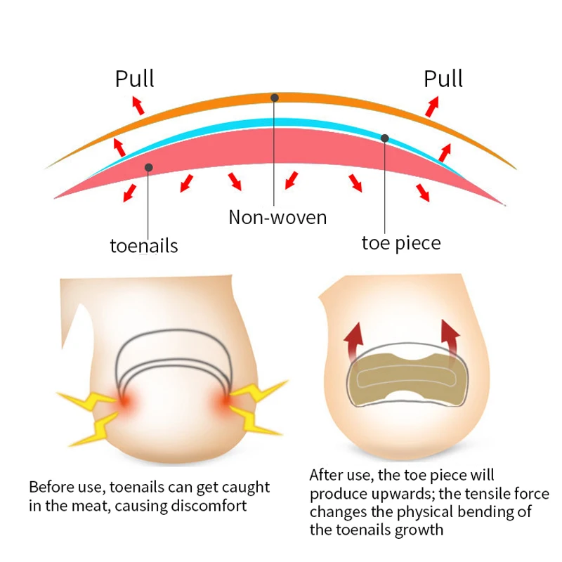 1-5Sheet вросшие ногти для ног &quotфранцзуский маникюр&quot корректор Стикеры пальцев