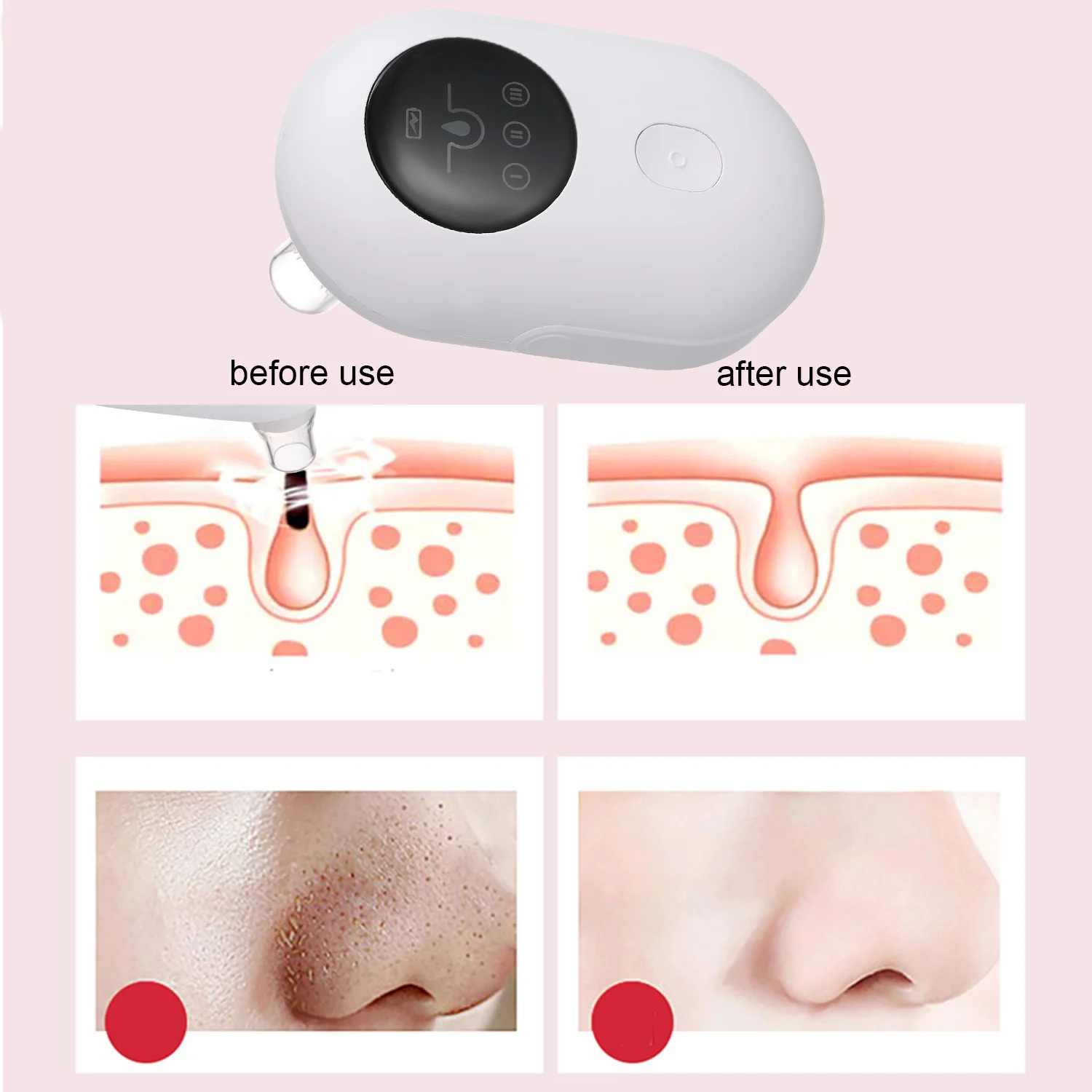 Прибор для вакуумной чистки лица 3 уровень всасывания электрическое средство