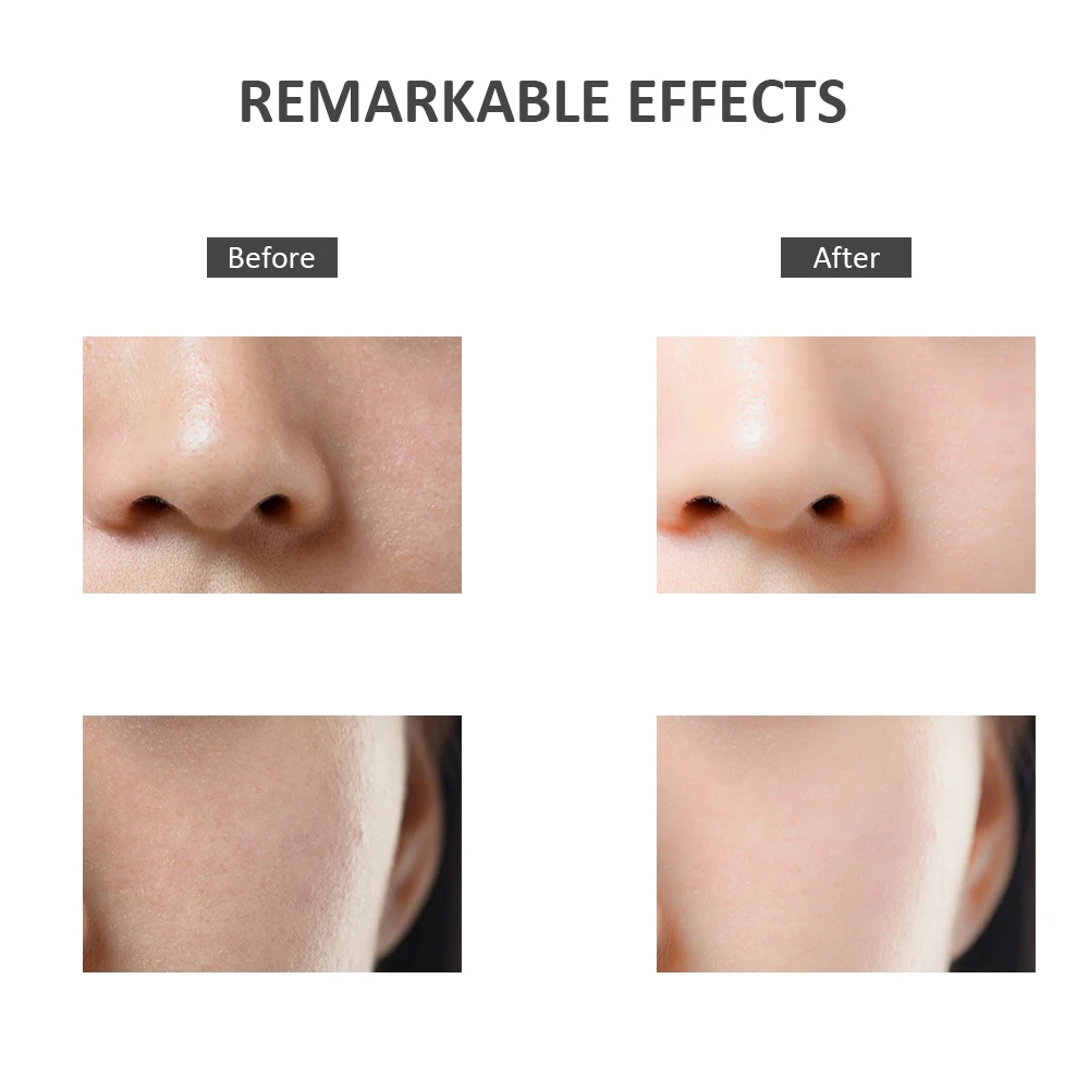 Электрическая лопатка для удаления черных точек аппарат глубокой очистки пор 45