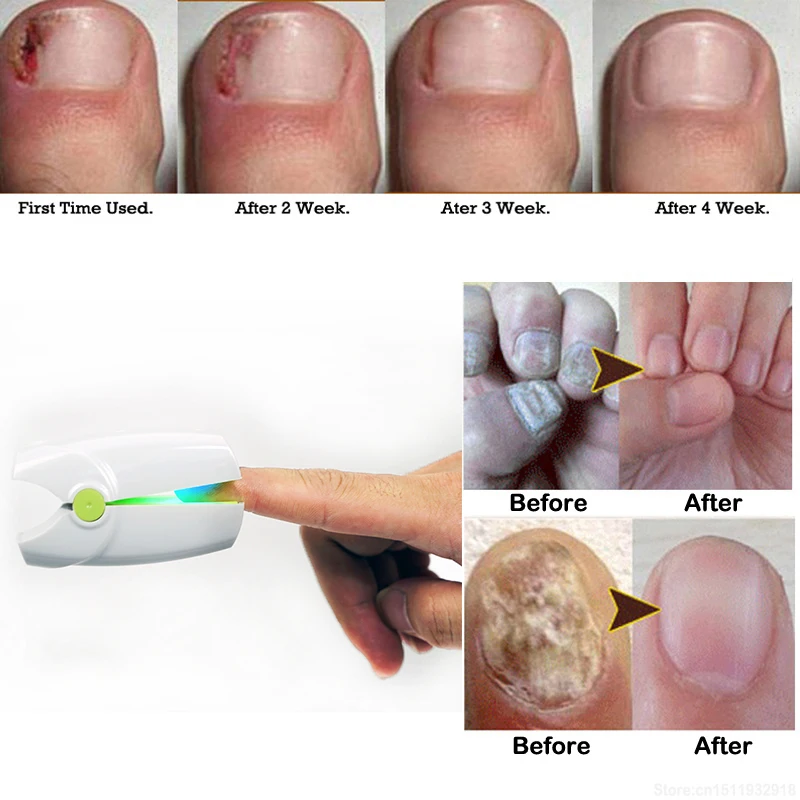 Stop Nail Fungus Infection Low Level Laser Therapy LLLT Toenail FungaI Treatment Onychomycosis Paronychia Micose Das Unhas |
