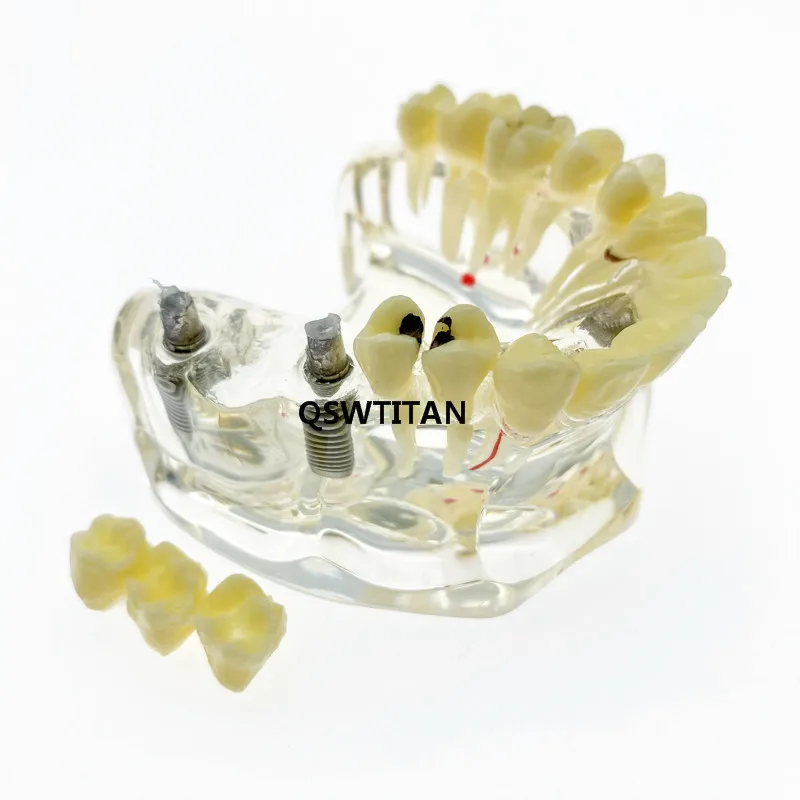 Модель зубного импланта с имплантатом и коррекцией кариес стоматологическое