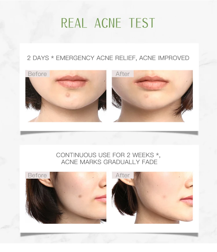 100% натуральное эфирное масло чайного дерева UONOFO экстракт против морщин удаление