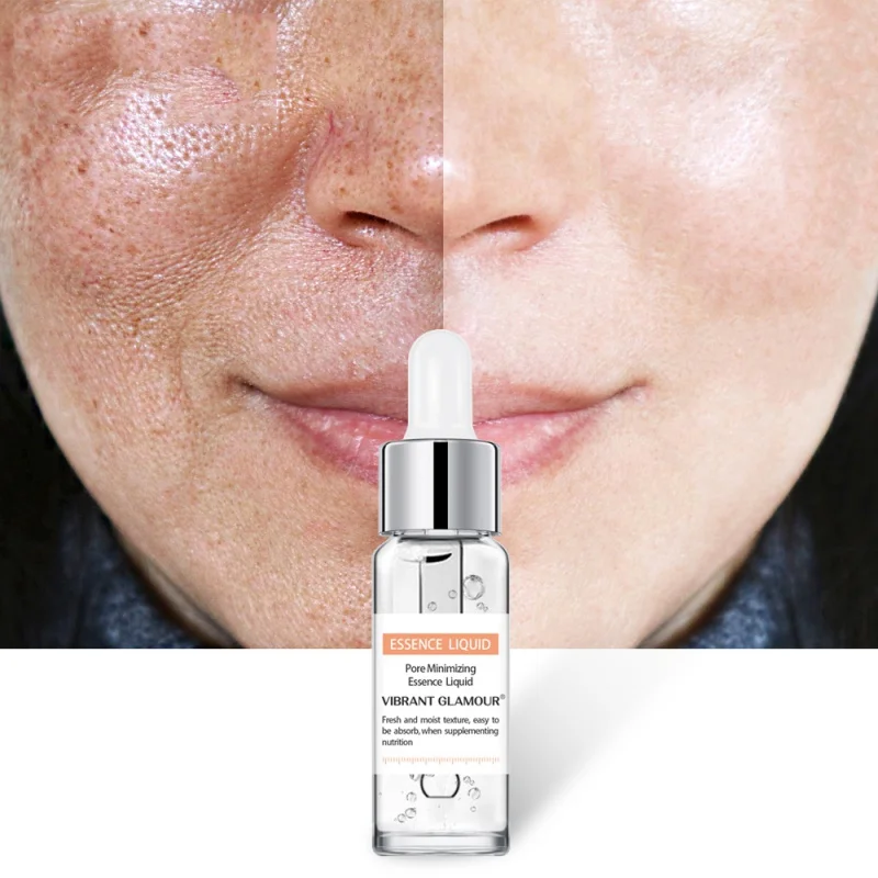 Салициловая кислота раствор для контроля жирности Удаление прыщей угрей