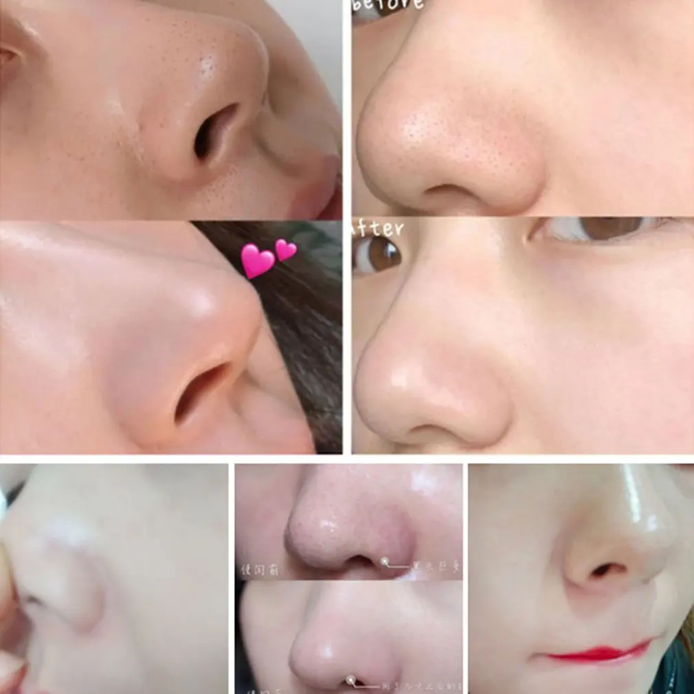 Electric Blackhead Remover Needles Acne Black Spot Extractor Vacuum Suction Deep Cleansing Machine Exfoliating Pore Cleaner | Красота и