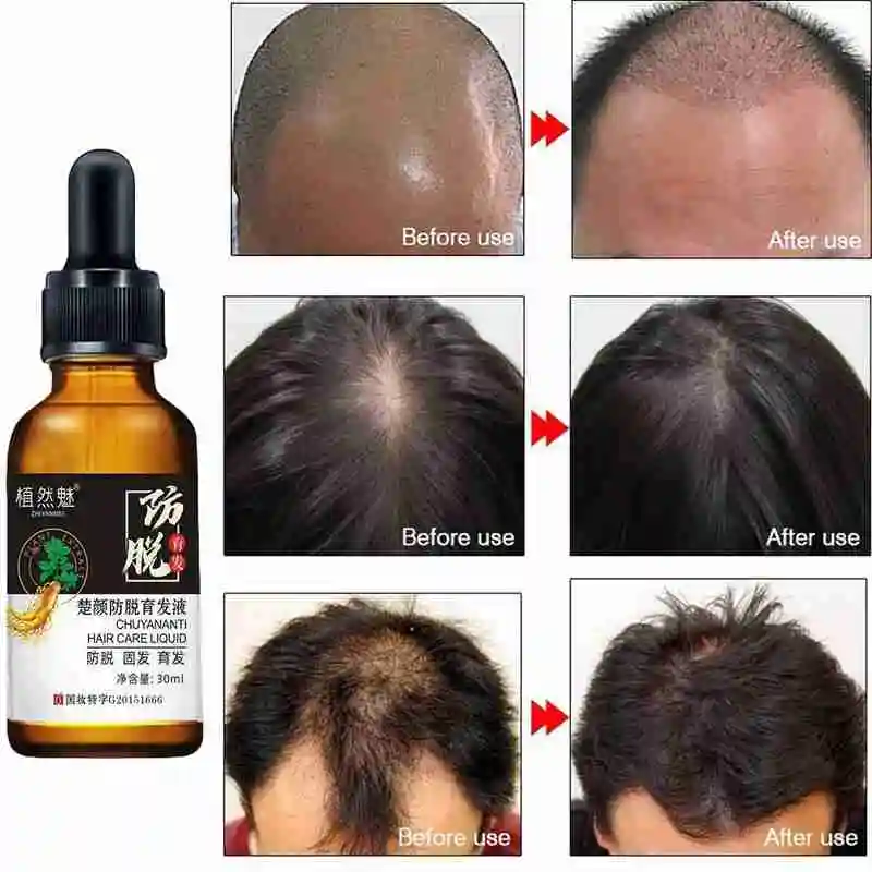 

30Ml Hair Care Anti-Hair Loss Plant Essence Herb Natural Care Hair Oil Relief Hair Skin Promote Hair Growth