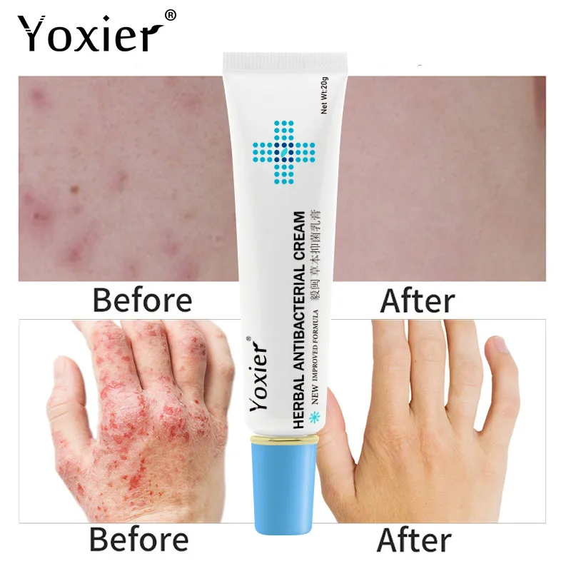 Антибактериальный крем Yoxier эффективное средство против зуда псориаз дерматит