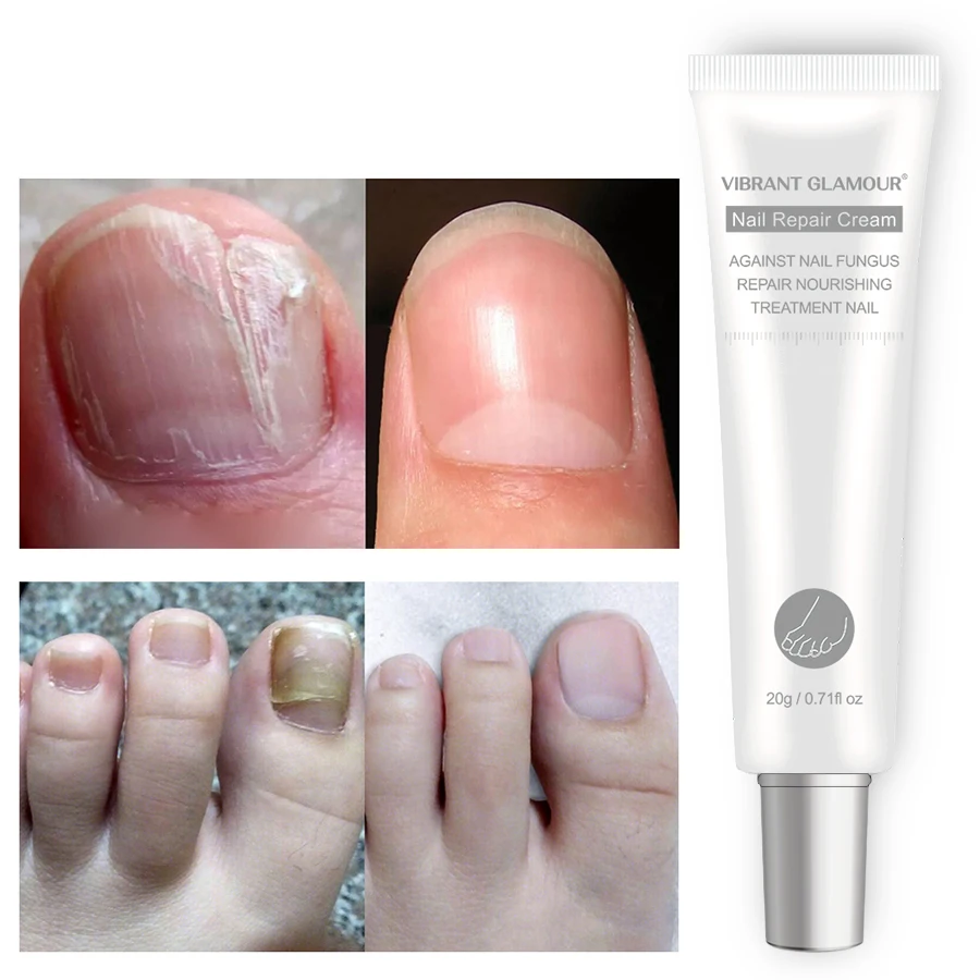 Яркий гламурный крем для восстановления ногтей Лечение онихомикоза удаление
